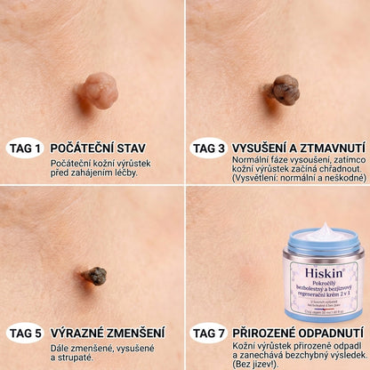 𝐇𝐢𝐬𝐤𝐢𝐧® 2-in-1 Pokročilý bezbolestný krém pro péči o pokožku bez viditelných stop – pro kožní výrůstky, bradavice a viditelné nedokonalosti pokožky